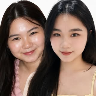 她说：“以前拍照时，总觉得自己笑起来不好看。”
脸宽、咬肌明显、嘴唇太薄——这些问题曾让她不敢微笑。

经过专业疗程后，她的脸型更小了，笑容也更柔和了。镜头前的她，不再躲避，而是闪闪发光。✨
