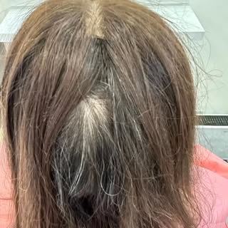 #hairlosssolution #meshintegrationsystem #hairreplacements #alopecia #hairloss