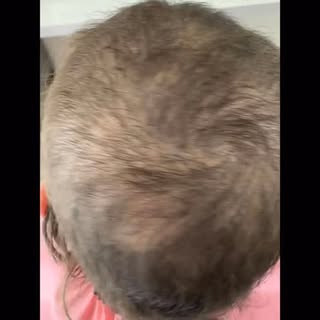 #hairlosssolution #hairloss #alopecia #femalehairloss #hairgoals
