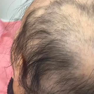 #femalehairloss #meshintegrationsystem #hairlossolution #hairloss #hair