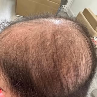#hairloss #hairlosssolution #hairsystem #nonsurgicalhairreplacement #meshintegrationsystem