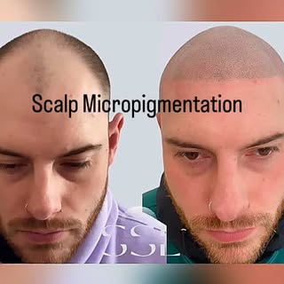 ✨ Restore Your Confidence with Scalp Micropigmentation (Hairline Tattoo) ✨

No surgery. No fuss. Jus