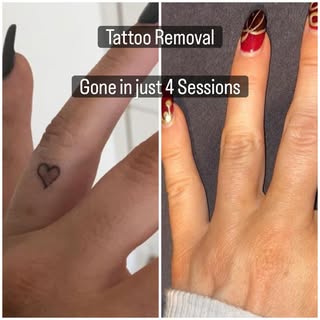 Completely gone after just 4 sessions! 🙌🏽

This tattoo has now fully faded, and the skin looks ama