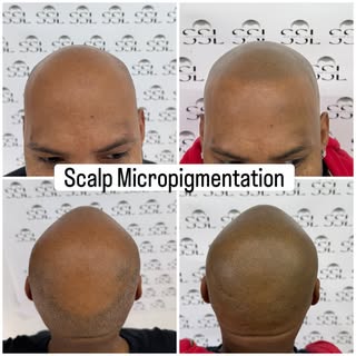 ✨ Confidence Restored. Natural Looking Results. ✨

The difference speaks for itself! 🙌

Our Scalp M