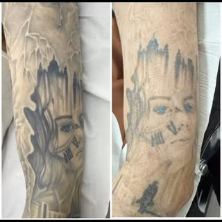 Look at the huge difference after just 2 sessions of tattoo removal on this sleeve! ✨

Tattoo remova