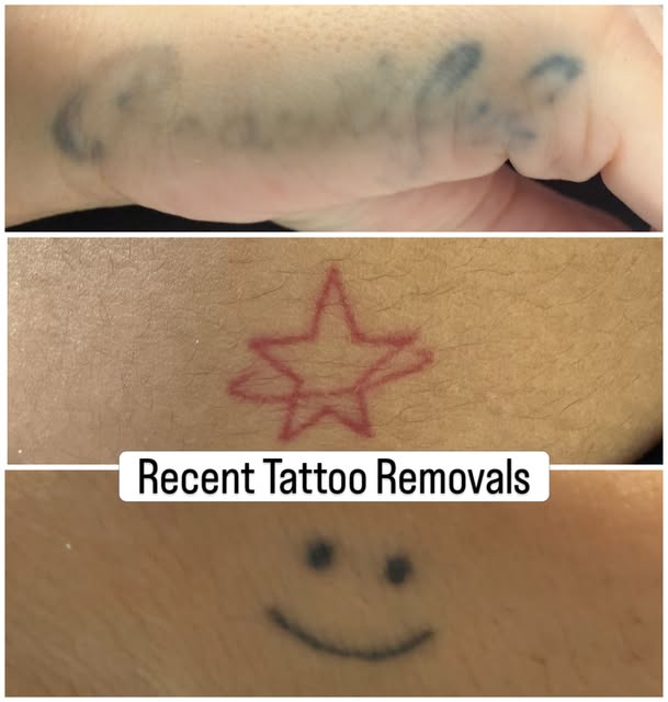 Just a few of the recent tattoos I’ve started removing ✨

Got a tattoo you no longer want, or simply