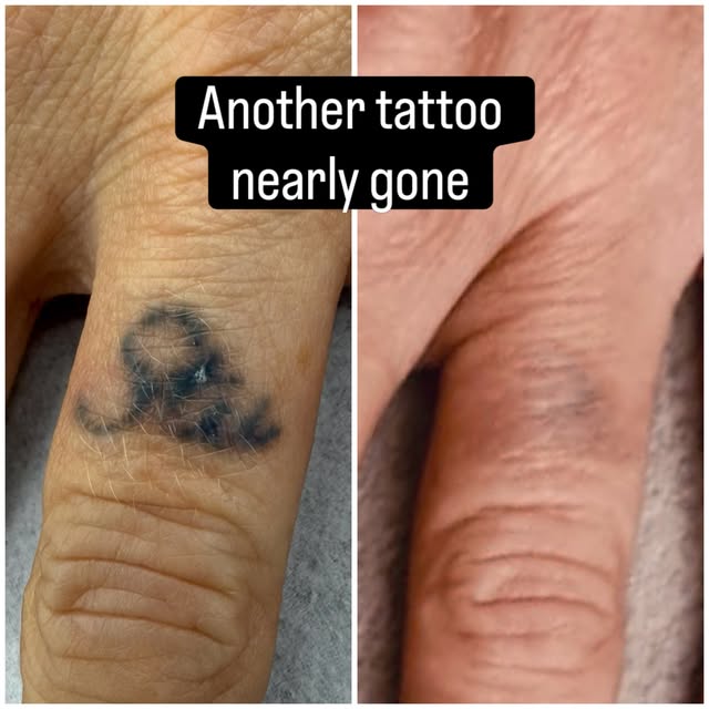 ✨ Nearly gone! Before ➡️ After

Another amazing tattoo removal transformation using laser technology