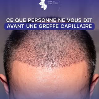 On parle souvent de la greffe… mais rarement de l’après.

Les premiers jours, le shock loss et le su
