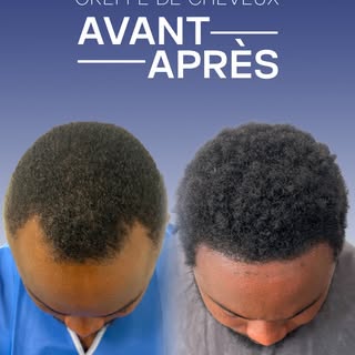 Des résultats qui parlent d’eux-mêmes ✨

Grâce à une greffe capillaire réalisée sur mesure, la ligne