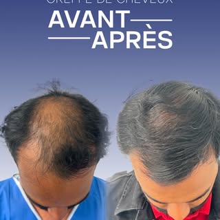 Un avant/après qui parle de lui-même ✨

Grâce à une greffe capillaire adaptée à ses besoins, notre p