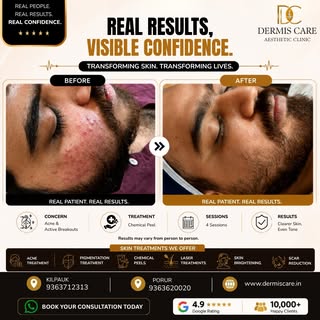 Real skin. Real treatment. Real results. See the difference

Acne and active breakouts can affect bo