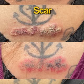 Want to remove an unwanted tattoo safely?

If your tattoo no longer matches your style or lifestyle,