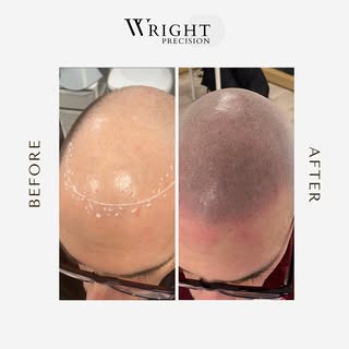 Before & After 

#scalpmicropigmentation #smp #hairloss #scalptattoo #hairtattoo #micropigmentation 