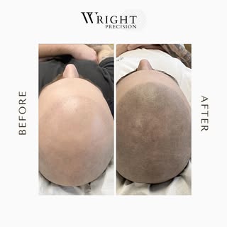 Before & After 

#scalpmicropigmentation #smp #hairloss #scalptattoo #hairtattoo #micropigmentation 