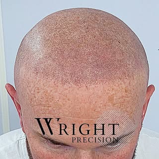 The hairline has be restored! Created in two sessions, another two remaining... stay tuned!