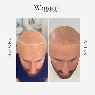 "Get the look you've always wanted with our micro-pigmentation services! Say goodbye to hair loss, t