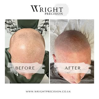 "Experience the remarkable difference with our micro pigmentation treatment. Before and after result