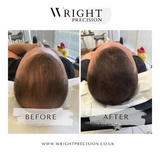 The impact of enhanced scalp density.. 

@wrightprecision 

#hairlosshelp #hairtransformation #scalp