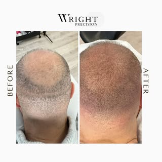 "Scalp micropigmentation effectively conceals scars from FUE and FUT hair transplants, blending them