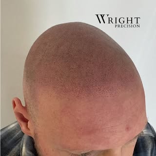 Transformation 

#smp #sma #sd #scalpmicropigmentation