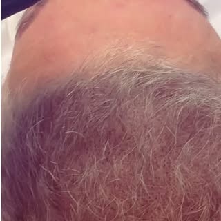 Leveling Up: Why SMP is the Ultimate "Cheat Code" for Hair Density
If you’re noticing your scalp pee