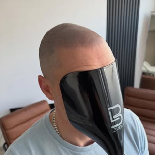 What a difference four sessions can make. A restored hairline and renewed confidence, achieved with 