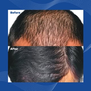 Visit our Before-and-After gallery to see results from actual Precision Hair Restoration clients. Ev