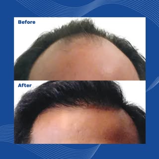 Hair restoration results develop gradually and naturally. Most patients begin seeing early growth ar