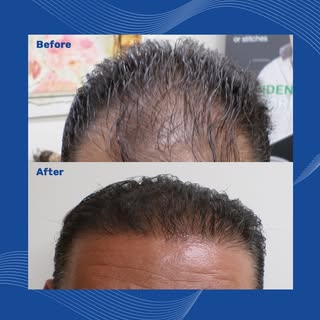 Whether your hair loss is in the early stages or more advanced, Precision Hair Restoration offers cu