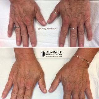 A little IPL can make a big difference. 💫

These before & after hand rejuvenation results show impr
