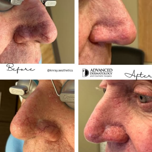 ✨ Nose Vein Removal | Before & After ✨

A subtle treatment with a beautiful difference! GentleMax Pr