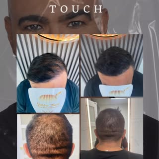 Hair transplant density job 1st session. Contact Dr. Q directly at 954-477-7785 by calling, texting 