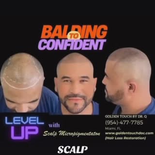 Your Hair Loss Solution. (Scalp Micropigmentation) at Golden Touch by Dr. Q. For receding hairlines,