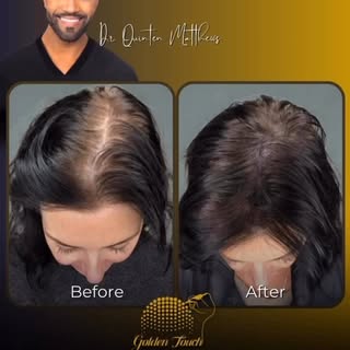 Golden Touch By Dr. Q (scalp Micropigmentation hair restoration service). Located in Miami, FL. I’m 