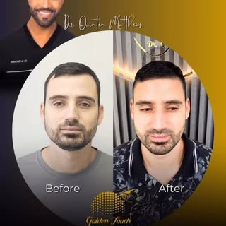 Golden Touch By Dr. Q (scalp Micropigmentation hair restoration service). Located in Miami, FL. I’m 