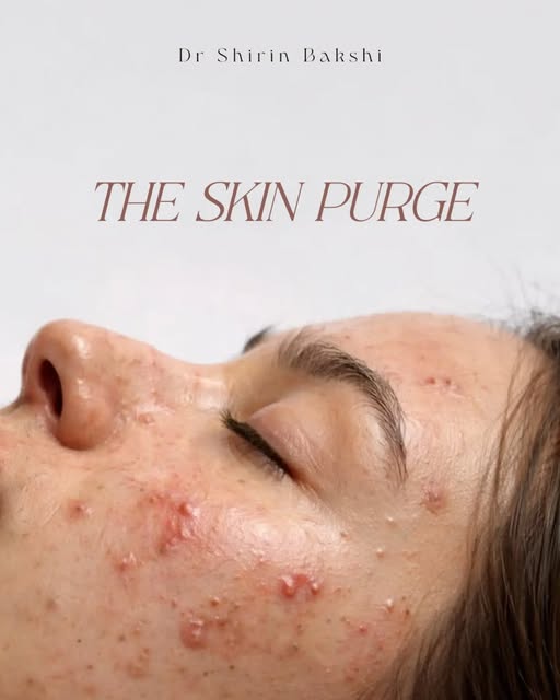 Skin purging can happen when your skin is adjusting to certain active ingredients—but not every brea