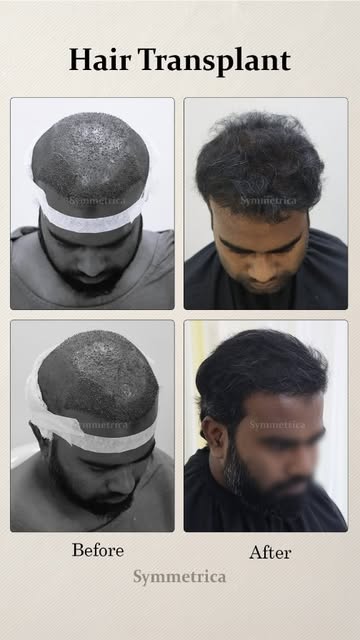 Hair Transplant Cleint from Hoogly District, WB, shares his HT journey at Symmetrica, Siliguri, WB.
