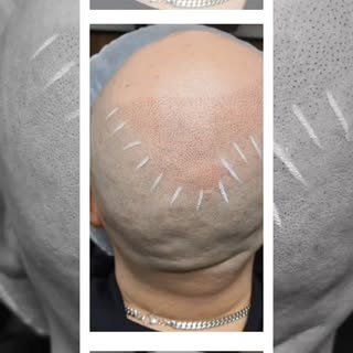 👉 Kent SMP Hair Loss Clinic
Are you suffering from hair loss?

Kent SMP Hair Loss Clinic 

If you w