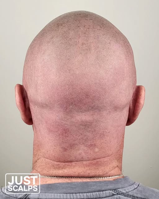 👉 Kent SMP Hair Loss Clinic
Showing just how effective Scalp Micropigmentation (SMP) can be, even w
