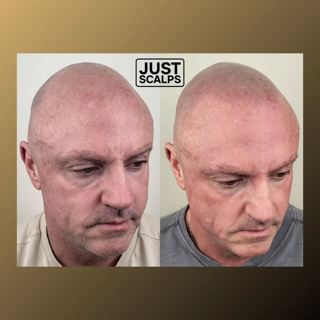 👉 Kent SMP Hair Loss Clinic
Proven results, time and time again 👇

REGAIN YOUR CONFIDENCE

➡️ J U 