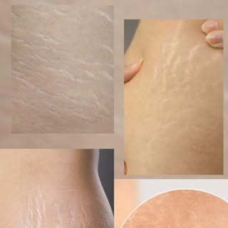 Stretch marks are more common than you think. ✨

They can appear due to growth, weight changes, preg