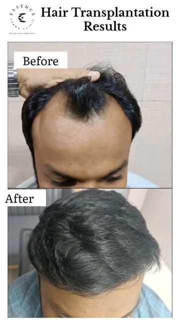 From thinning hair to renewed confidence. ✨

Real Hair Transplantation results, documented over time