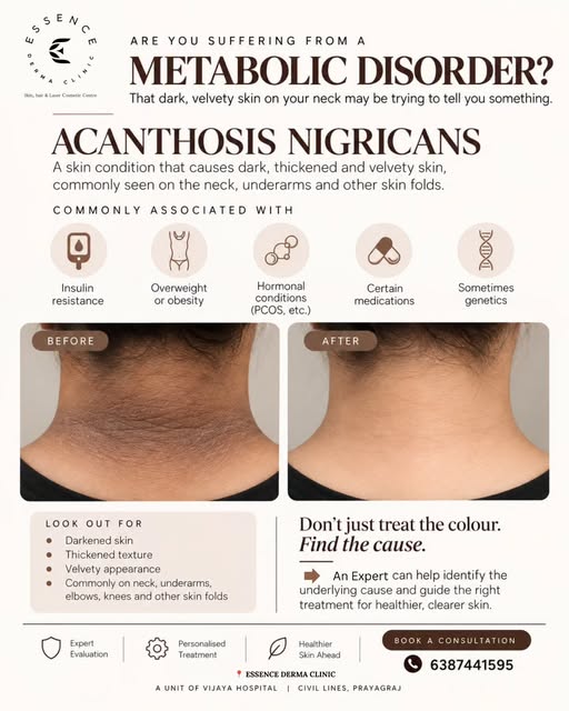 That dark, thickened, velvety skin on your neck may be more than just pigmentation. 🤎

Acanthosis N