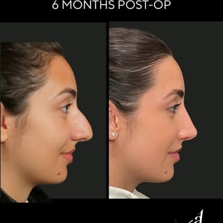 We couldn’t get her to stop smiling in these After photos!😆💫
Here’s our awesome patient now 6-mont