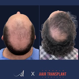 Natural hair restoration is all about the details✨
From hairline design and density to growth direct