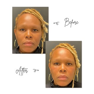 When your cheek filler is done right, nobody asks if you got something done. They just say you look 
