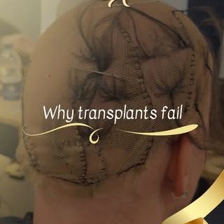 If you have alopecia and you've been told a transplant is your best option...

Whoever told you that
