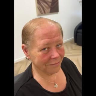 ✨ A transformation that speaks for itself ✨

From visible hair loss and thinning to a fuller, natura