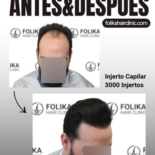 🚀 ¿Es posible revertir una alopecia avanzada y recuperar el marco facial? Juzga tú mismo este resul