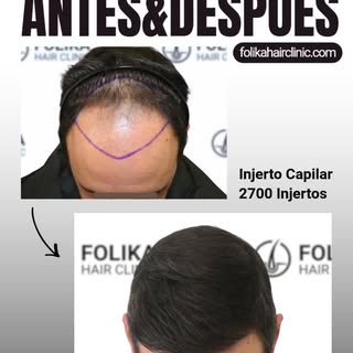 🤔 ¿Sientes que la alopecia avanza sin control en tus entradas y desdibuja tu línea frontal? 

Fíjat